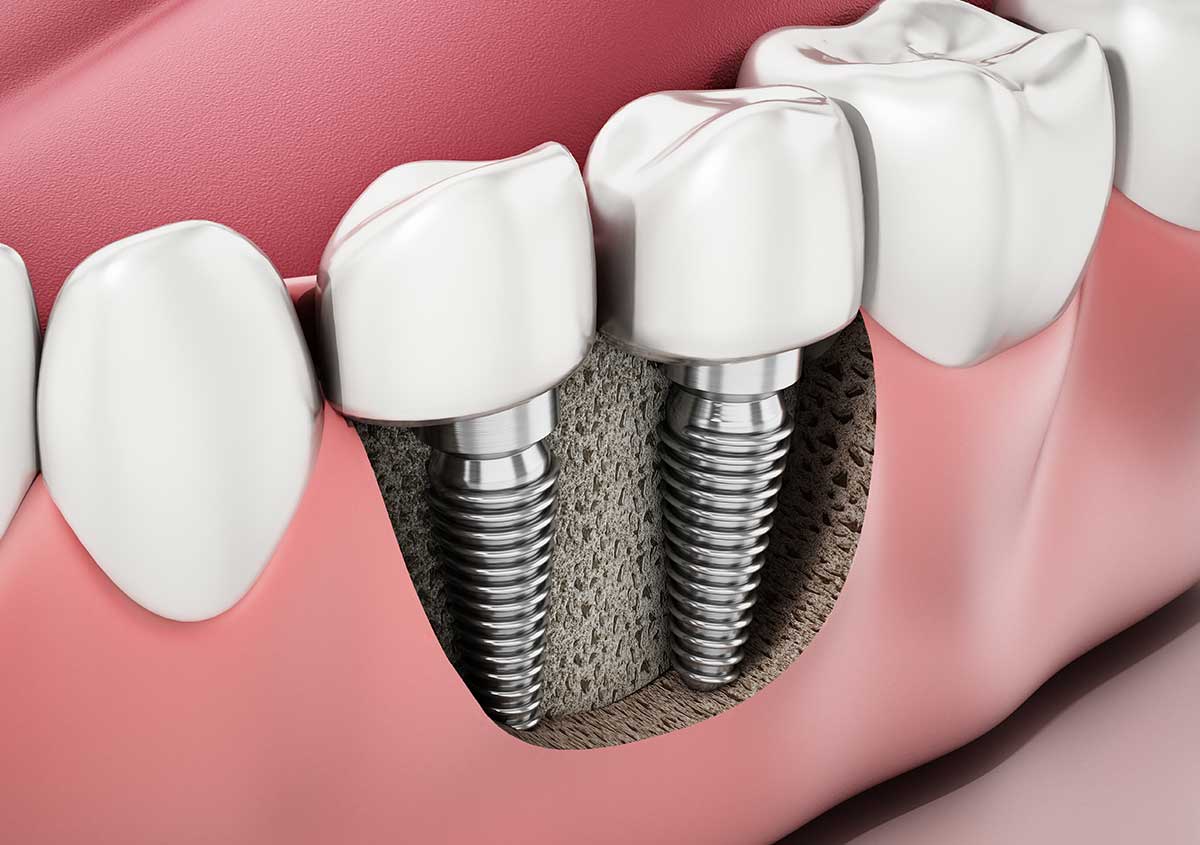 Healing Process of Tooth Implant in Oakville ON Area